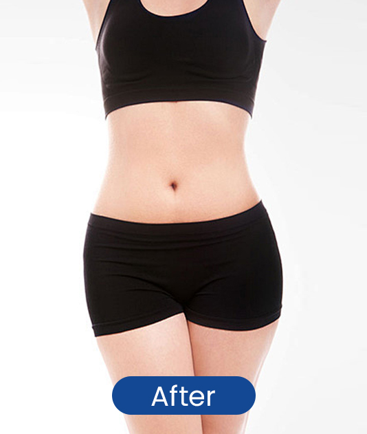 After waist contour sculpting result