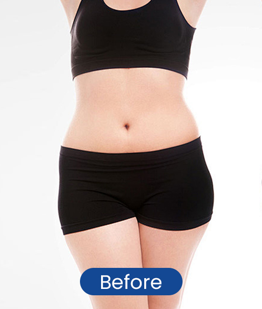 Before waist contour sculpting result