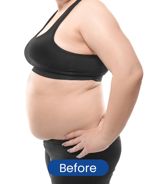 Before full body sculpting result